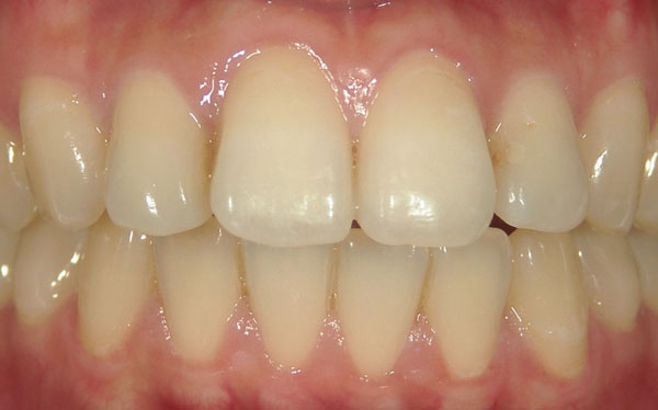 ホワイトニング症例