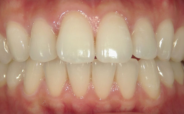 ホワイトニング症例