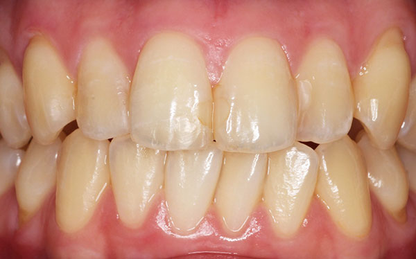 ホワイトニング症例