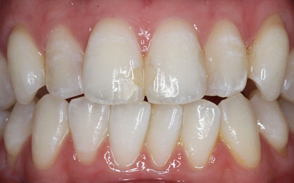 ホワイトニング症例