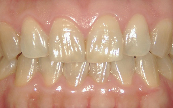 ホワイトニング症例