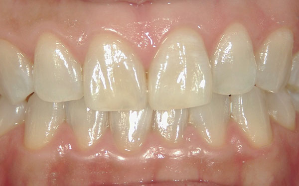 ホワイトニング症例