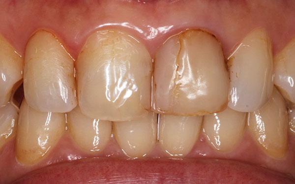 ホワイトニング症例