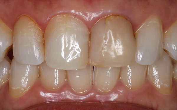 ホワイトニング症例