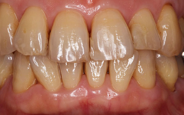 ホワイトニング症例