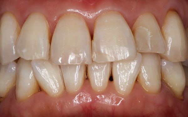 ホワイトニング症例