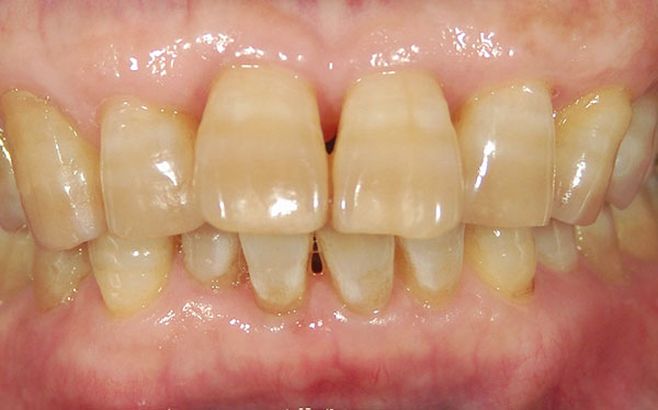 ホワイトニング症例