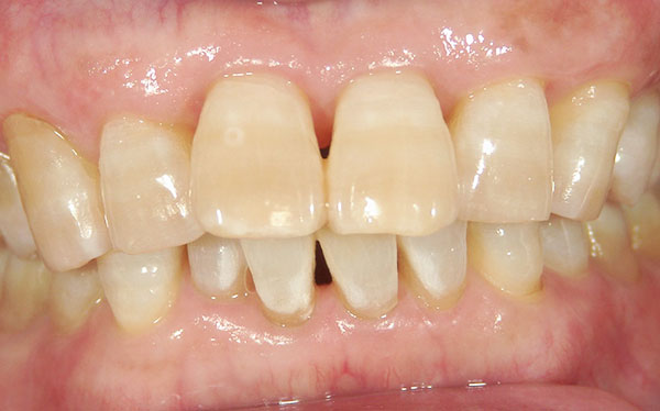 ホワイトニング症例