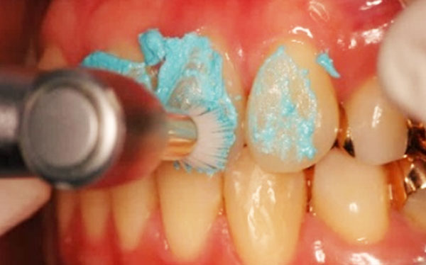 ③クリーニング