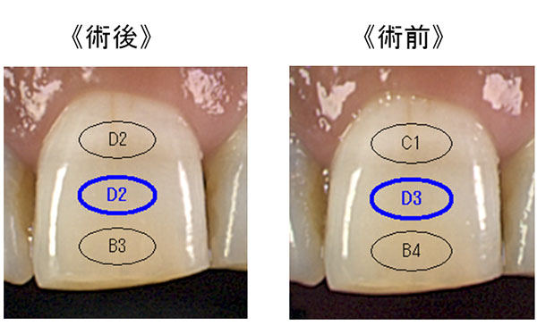 ⑦クリーニング・フッ素塗布