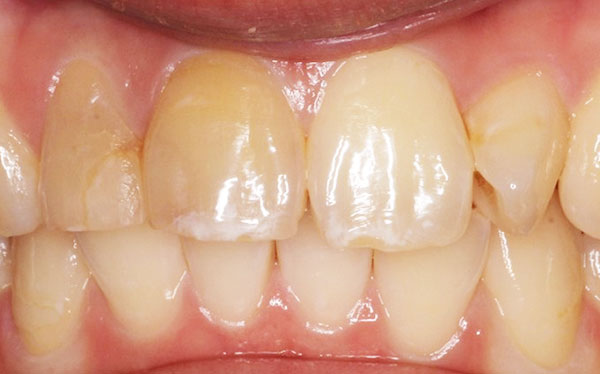 右上1番2番失活歯