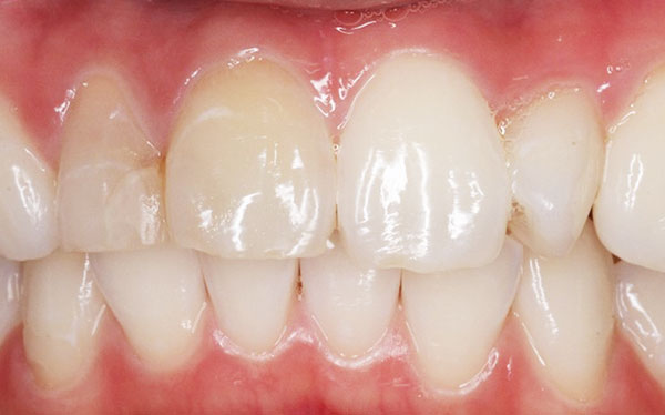 右上1番2番失活歯