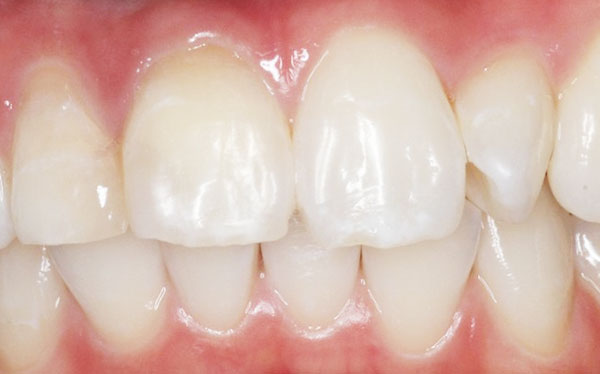 インターナルブリーチ施術後